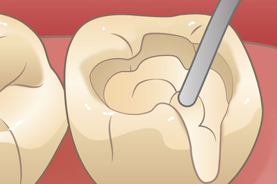 ダイレクトボンディング治療