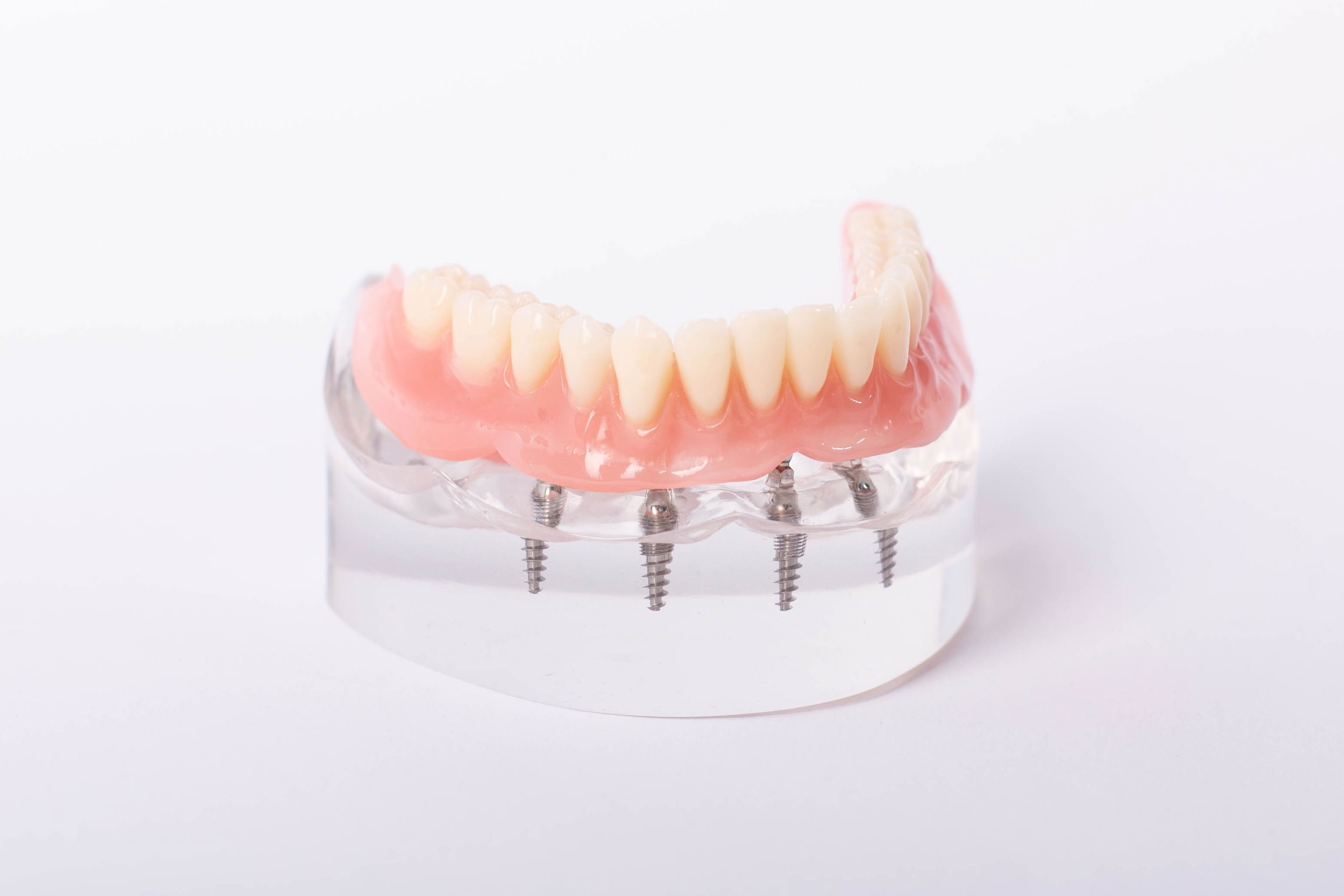 インプラントオーバーデンチャー