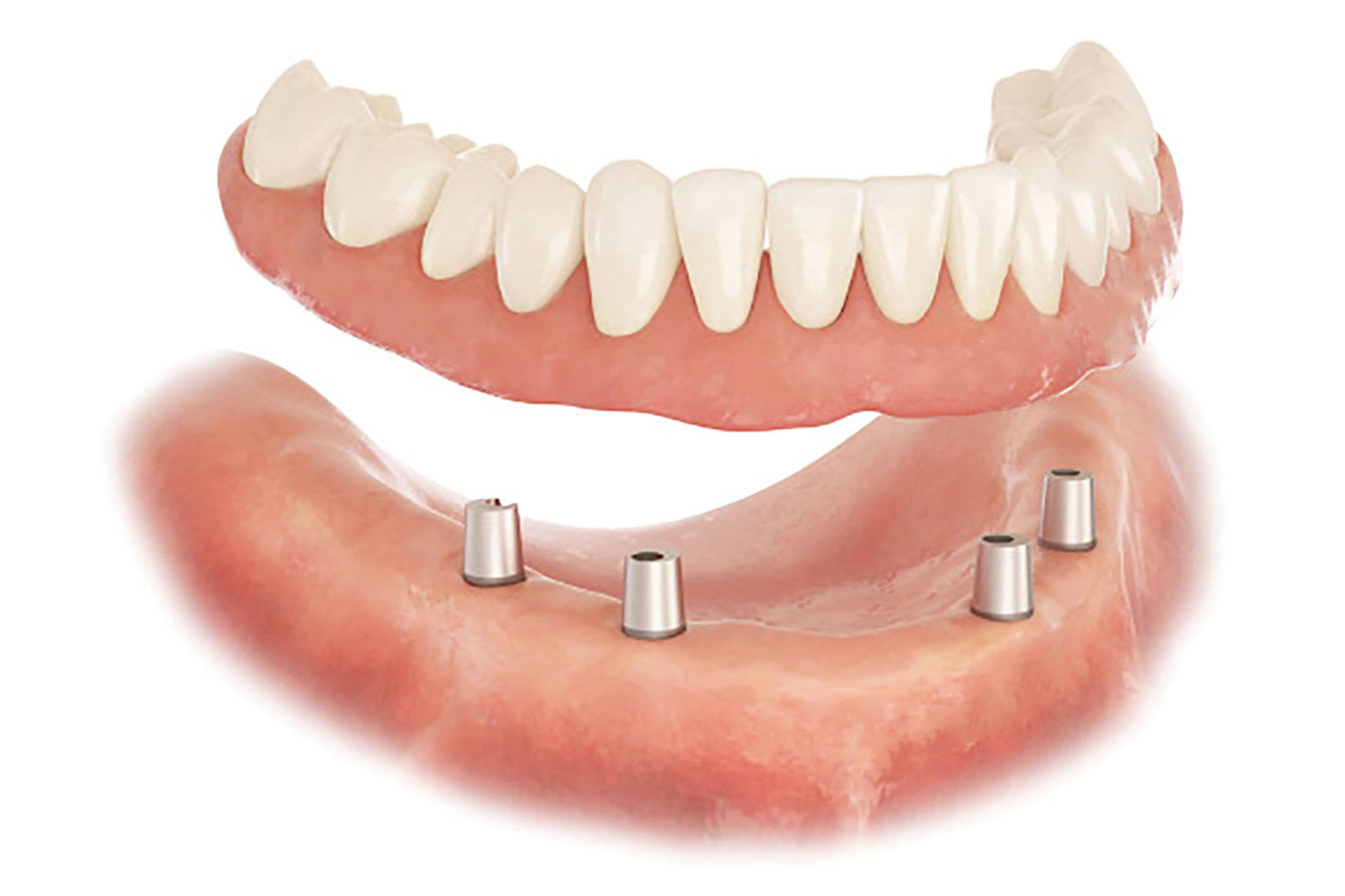 コーヌスデンチャー