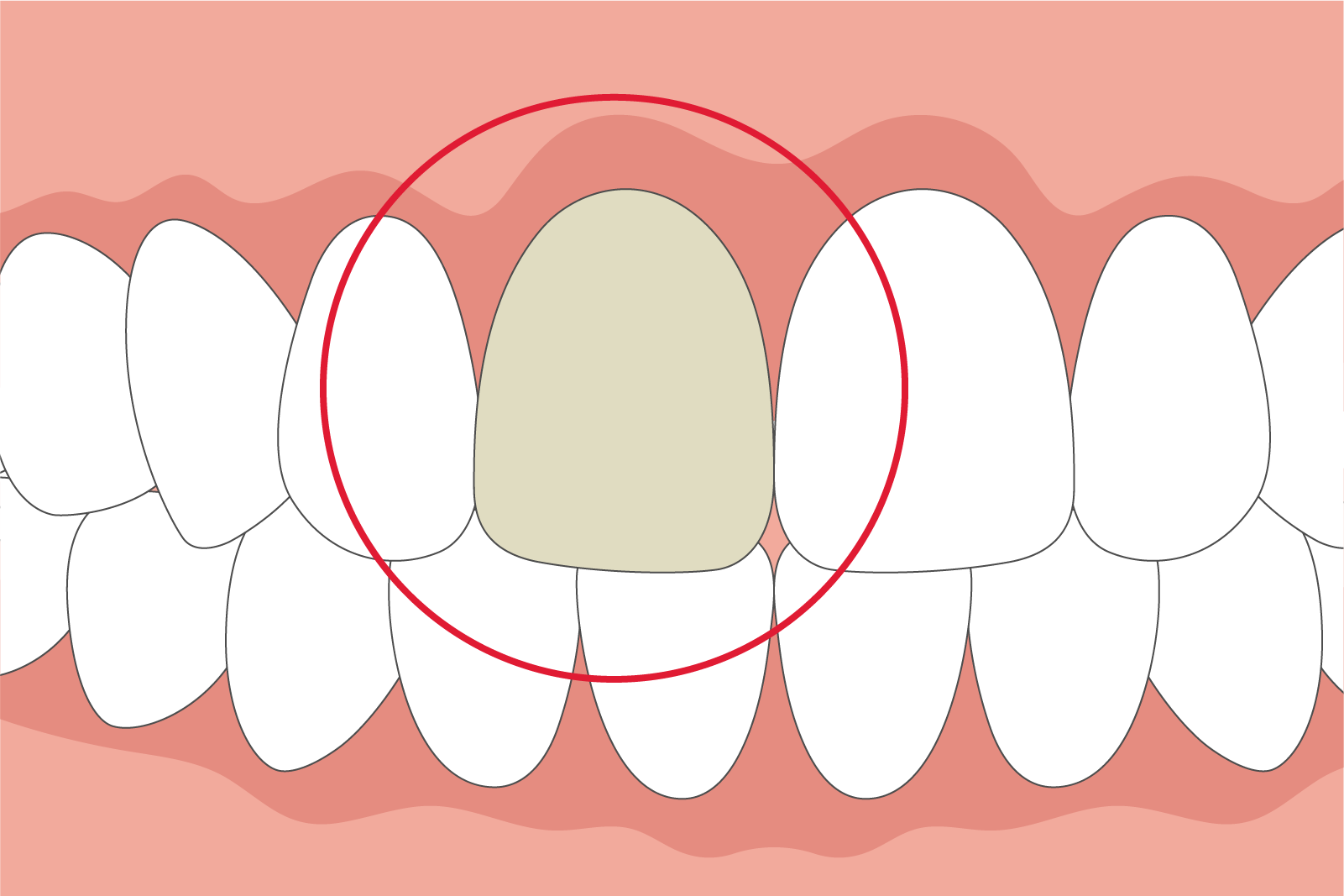 ウォーキングブリーチ