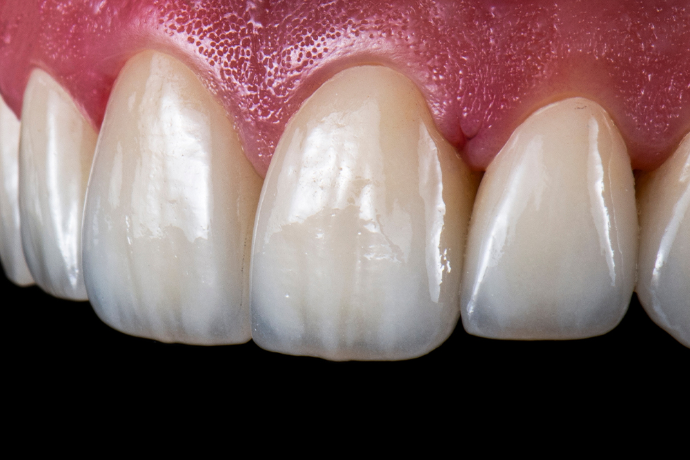 オールセラミック