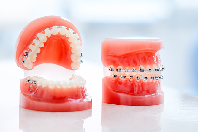 小児用ワイヤー矯正