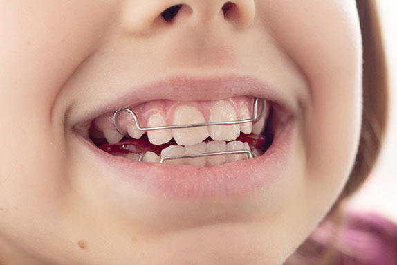 ベッグリテーナー