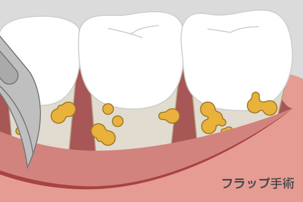 FOP(フラップ手術)