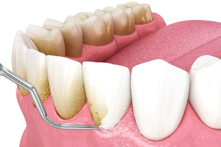 歯を守るための精密歯周治療