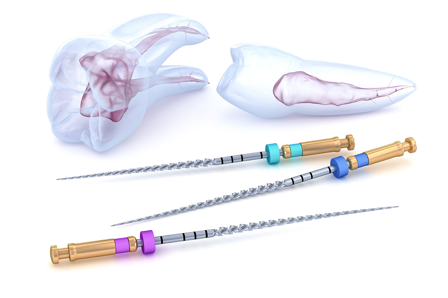 ニッケルチタンファイルで清掃