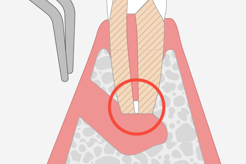 歯根端切除術(しこんたんせつじょじゅつ)