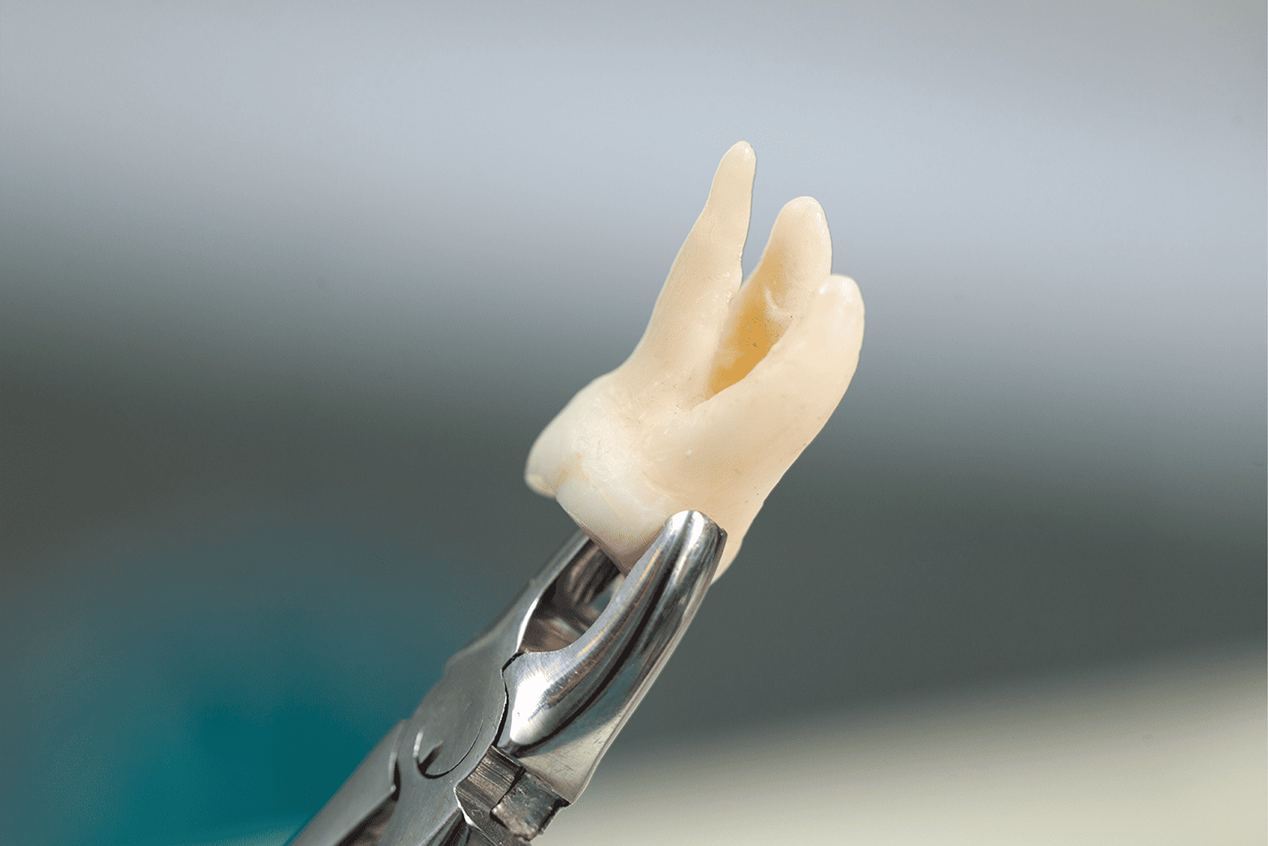 親知らずは抜いた方が良い?