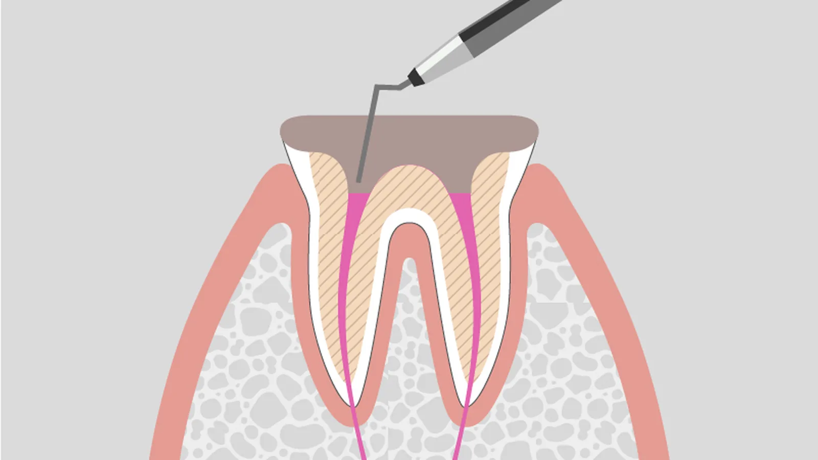 根管を器具で清掃している断面イラスト（ピンクの根管）